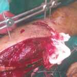 Fractures4