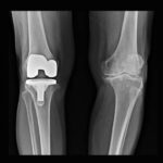 Film x ray :  Left knee   osteoarthritis disease ,  Right knee   total knee replacement surgery
