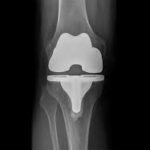 KNEE2