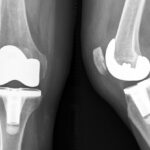 Knee X-ray image after a total knee replacement operation.   The diseased knee joint is replaced with artificial material (White parts).  Frontal view and side-view.