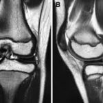 Meniscus4