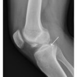 acl1