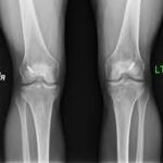 acl3