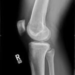 acl4