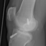 acl5