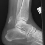 avulsion fracture2