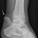 avulsion fracture4