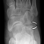 avulsion fracture5