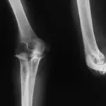 elbow-x-ray