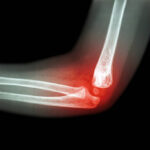 Rheumatoid arthritis , Gouty arthritis ( film x-ray child 's elbow with arthritis at elbow ) ( Side view , Lateral )