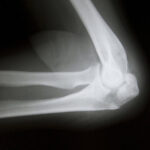 elbow-xray4