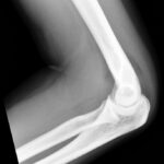 elbow-xray5