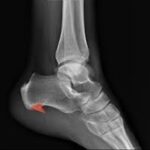 heel5
