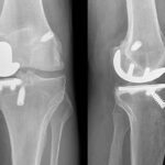 knee4