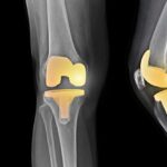 knee5