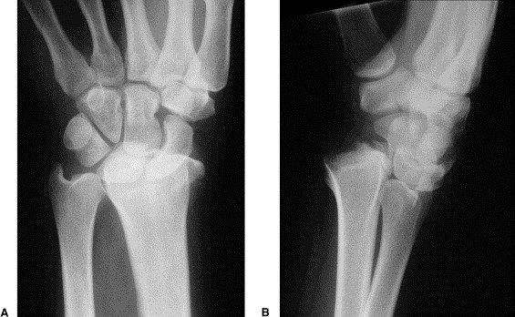 Intraarticular Fracture Care – swamisamarthhospital